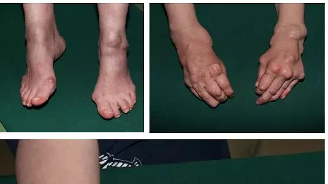 Image: Arthritis Prevention and Management, without Drugs