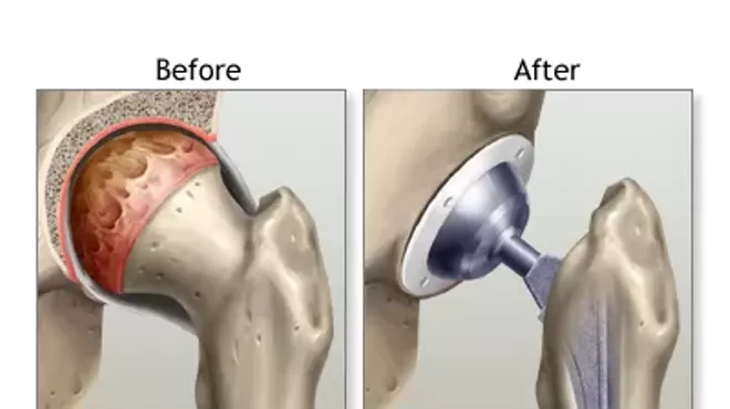 Image: Do I Really Need My Joint Replaced?
