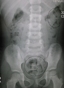 WIKIPEDIA — AN X-RAY VIEW OF CONSTIPATION